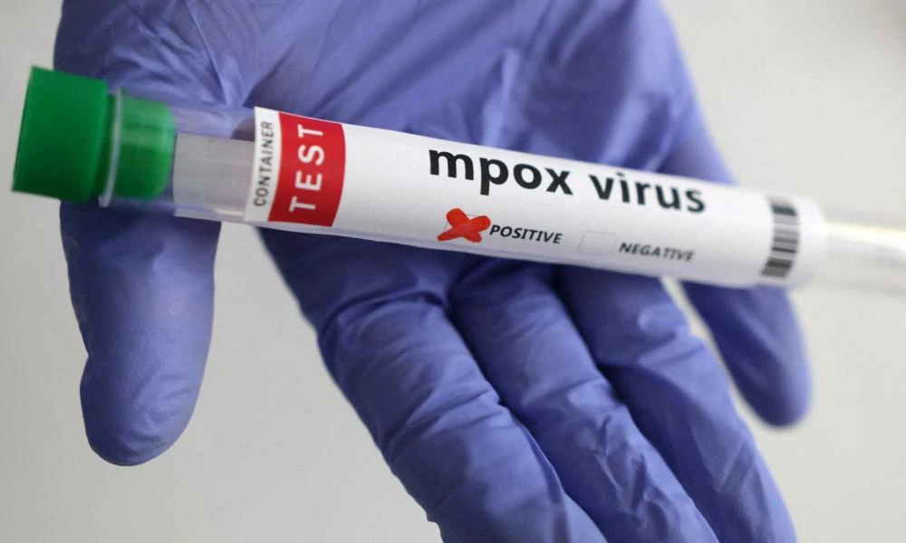 Εντοπίστηκε το πρώτο κούσμα του ιού mpox στη Βρετανία